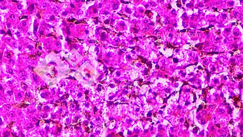 Imagen 4. Necrosis hepática focal con cuerpos de inclusión intranucleares anfofílicos ocasionales en la zona perinecrótica. Hígado.